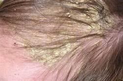 Calms Cradle Cap