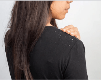 Reduces Dandruff and Controls Oil