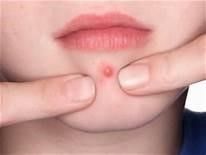 REDUCES ACNE & PIMPLES