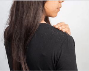 Reduces Dandruff and Controls Oil